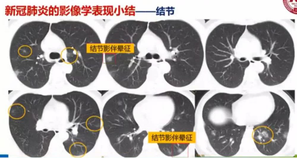 AI助力疫情防控，專利為其保駕護航！