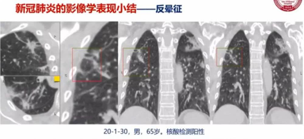 AI助力疫情防控，專利為其保駕護航！